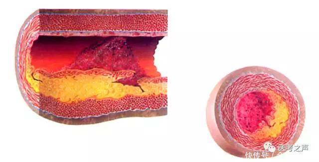 稳定型心绞痛? 到底是什么稳定?