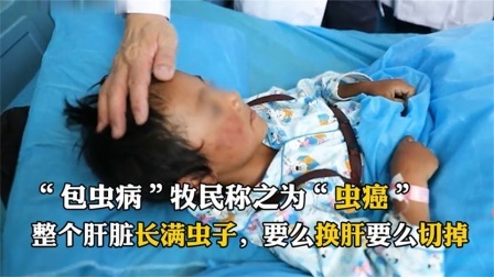 7岁男孩患上“虫癌”，医生开刀一看，拳头大的肝脏爬满虫子