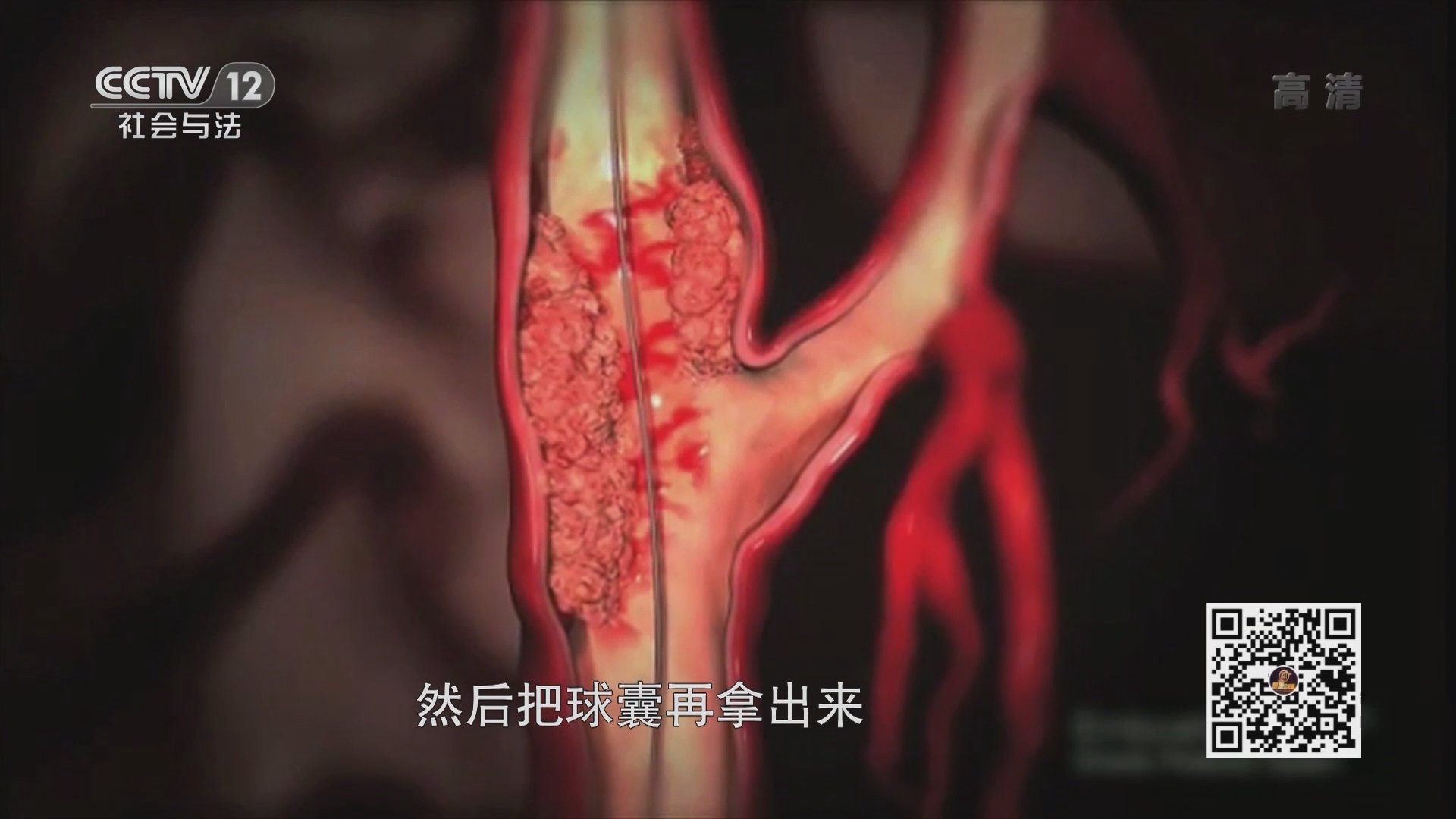 《夕阳红》 20211101 直通手术室-一枚支架能否拆除身上的定时炸弹？（上集）