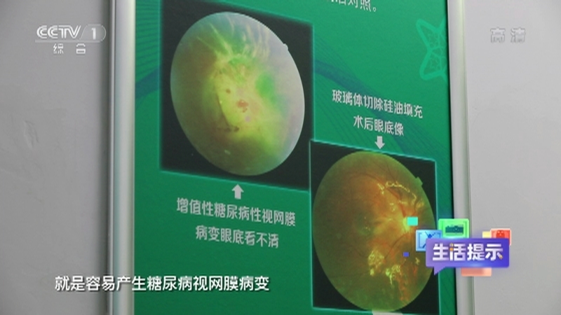《生活提示》 20211218 冬季警惕糖尿病眼病高发