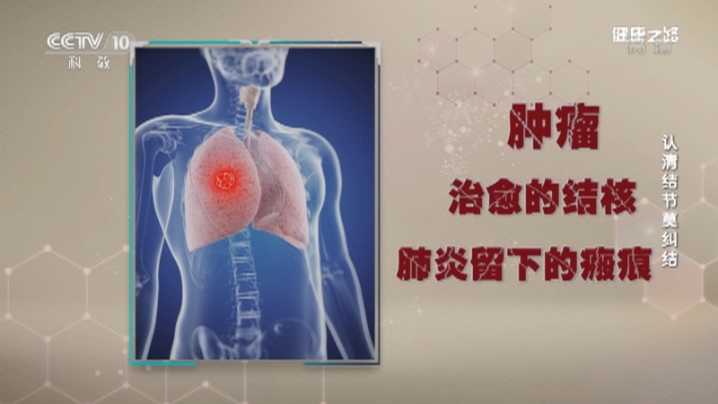 健康之路 《健康之路》 20201127 认清结节莫纠结