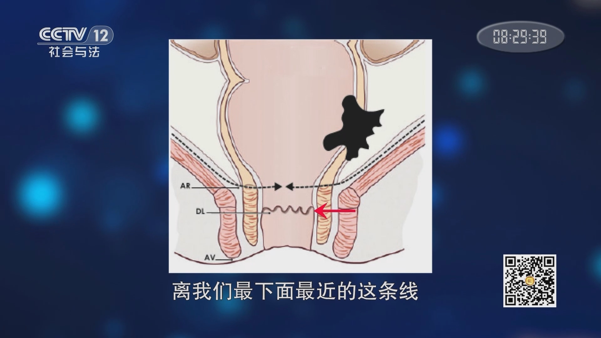 《夕阳红》 20211213 直通手术室-极限空间能否顺利保肛？（上集）