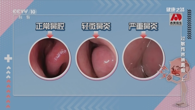 健康之路 《健康之路》 20220423 过敏传言辨真假（上）