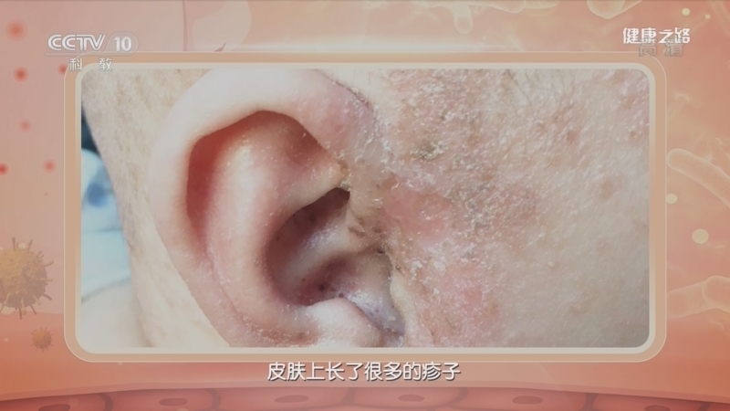 健康之路 《健康之路》 20220914 打好湿疹持久战