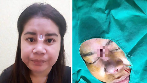 涨健识 女子隆鼻失败硅胶棒外露