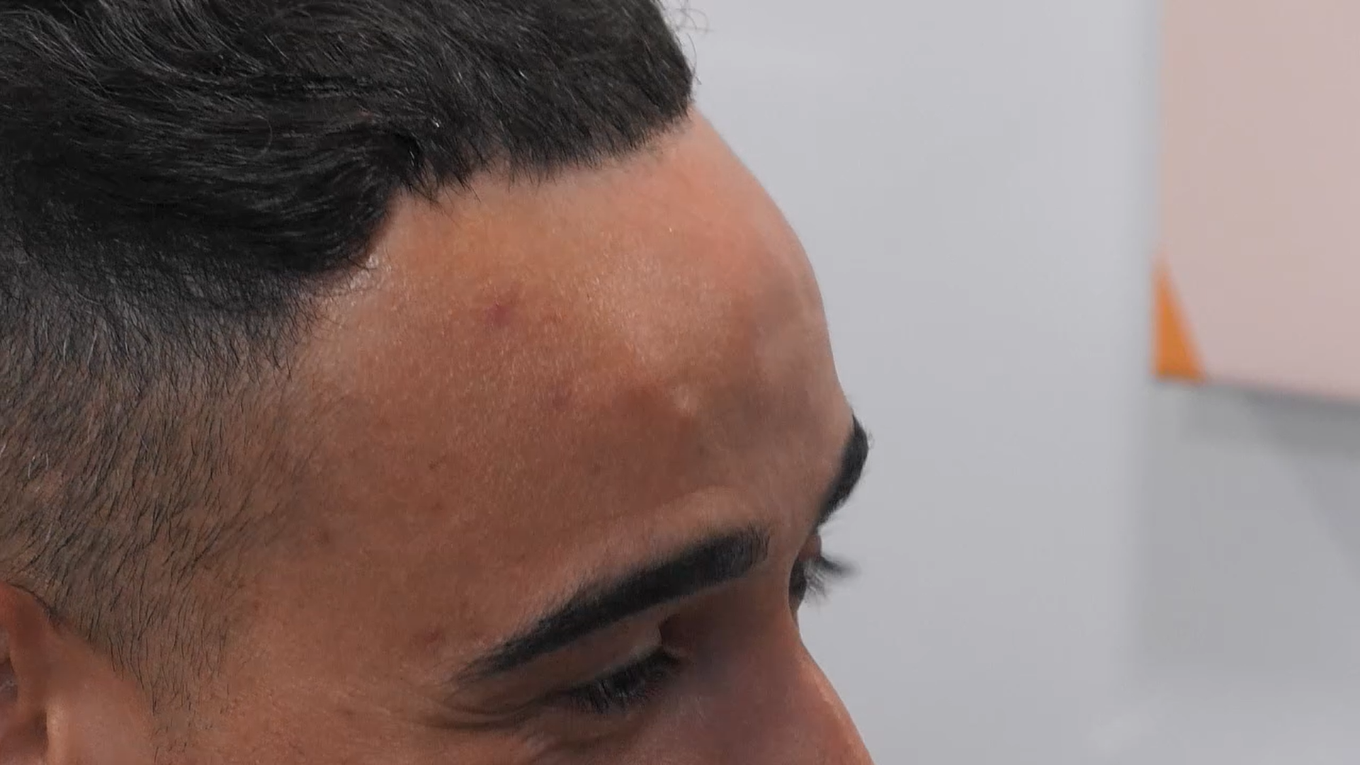 脖子后的巨大脂肪瘤