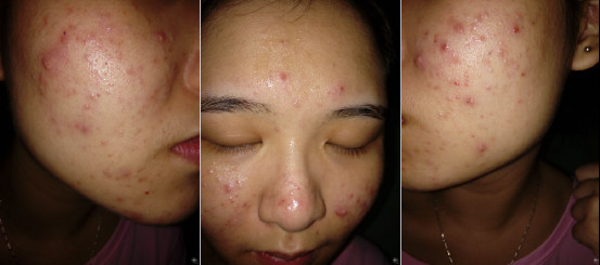 内毒不排,外痘不断!