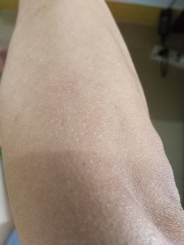 身上长鸡皮疙瘩图片(身上长的鸡皮疙瘩怎么回事)