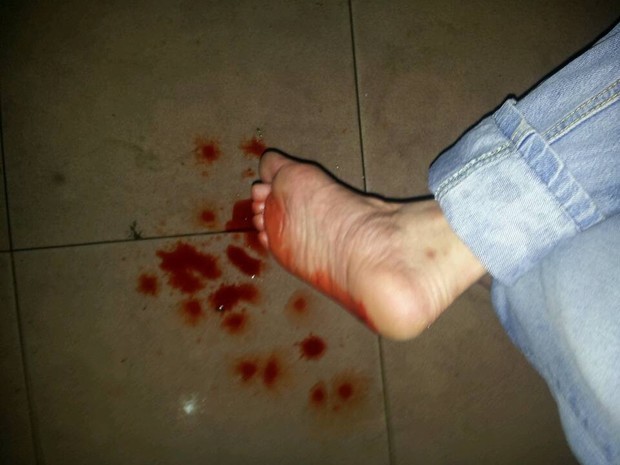 脚踩到玻璃流血的图片图片