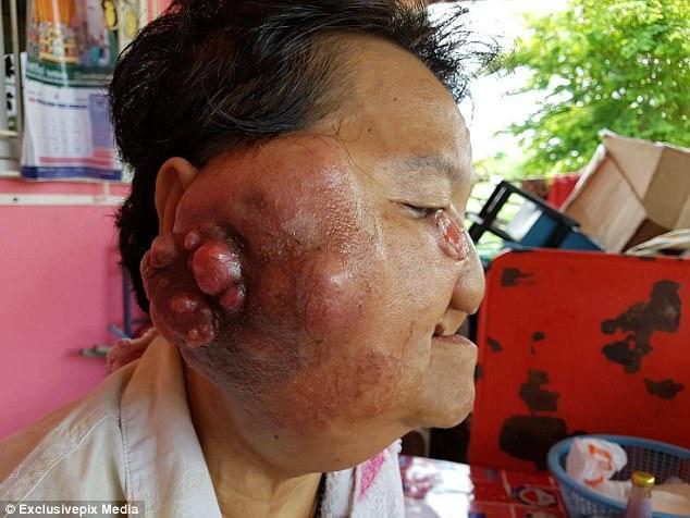 泰国女子脸旁长巨型肿瘤 眼睛几乎看不见了