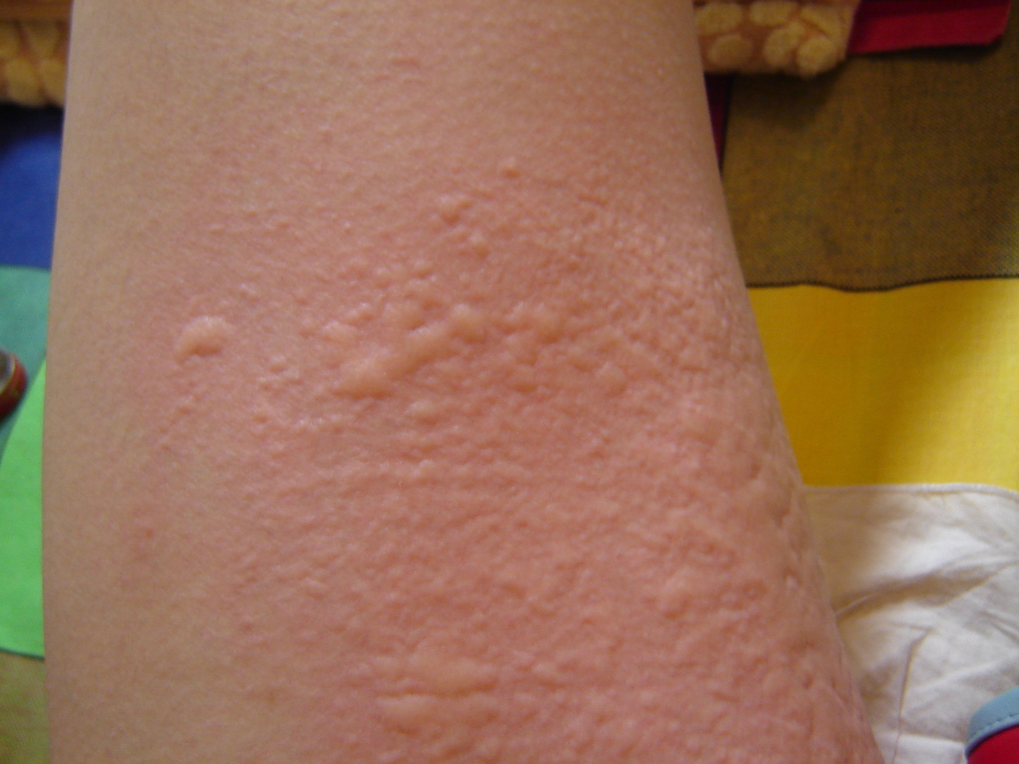 荨麻疹(urticaria)俗称风团,风疹团,风疙瘩,风疹块(与风疹名称相似,但